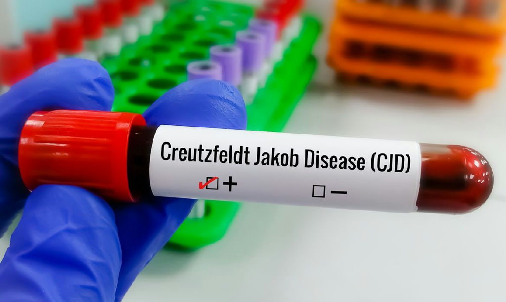 Doença de Creutzfeldt-jakob: entenda a condição rara e a busca por tratamentos