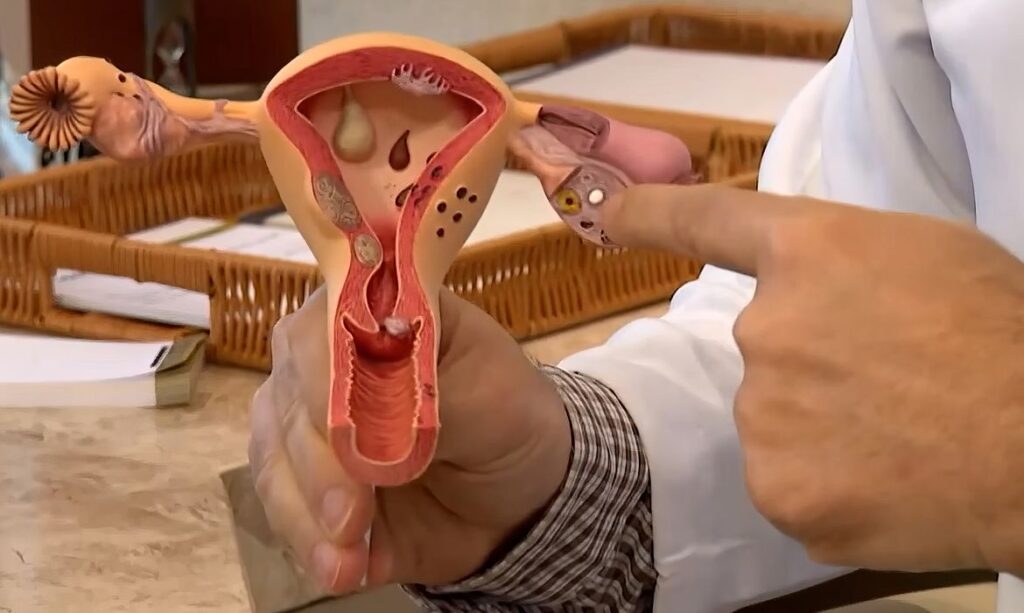 Endometriose: R$ 60 milhões em nova chamada para pesquisas e soluções no SUS