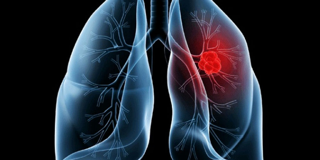 Após cirurgia do Papa Leão, entenda o adenocarcinoma pulmonar