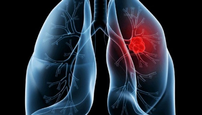 Após cirurgia do Papa Leão, entenda o adenocarcinoma pulmonar