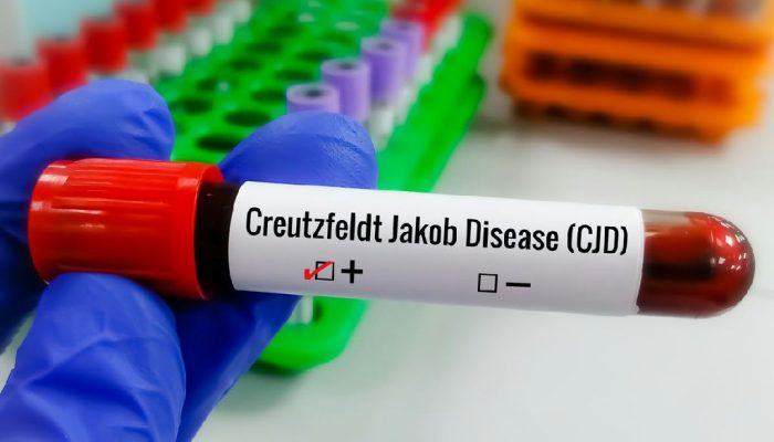 Doença de Creutzfeldt-jakob: entenda a condição rara e a busca por tratamentos