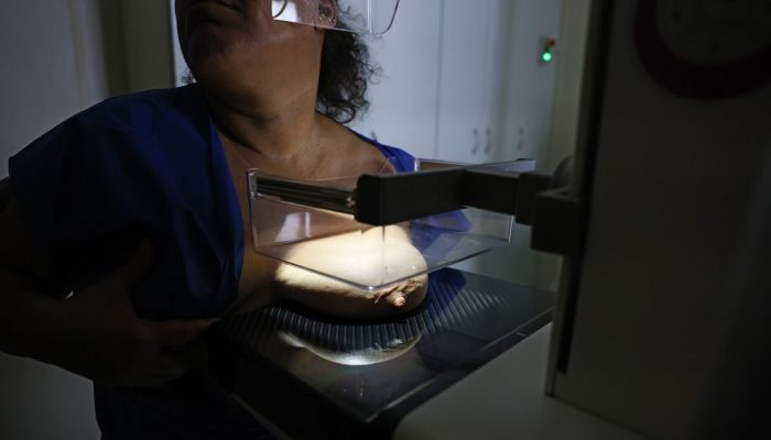 ANS defende fim de restrições para cobertura de mamografia digital em planos de saúde