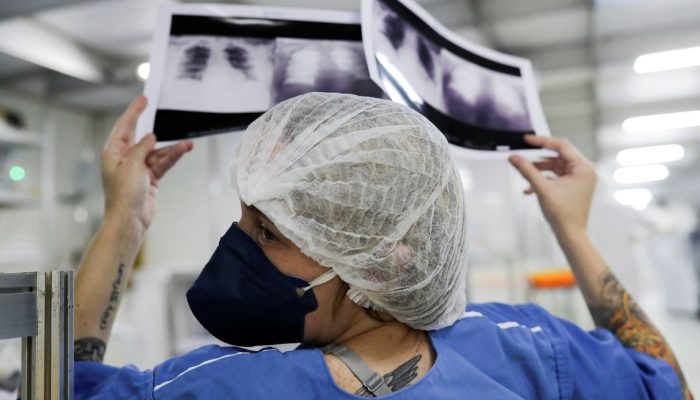 Milhares de pacientes com câncer de pulmão recebem diagnóstico tardio no SUS